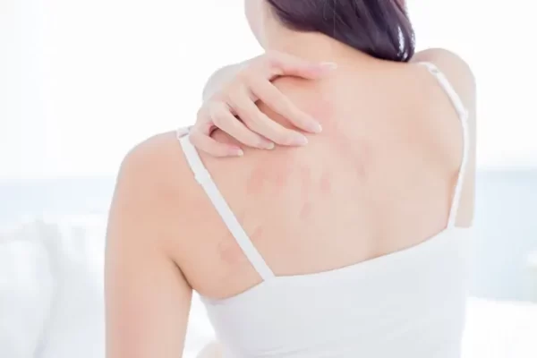 PM 2.5 dust and its effects on the "skin", burning - itching - rashes